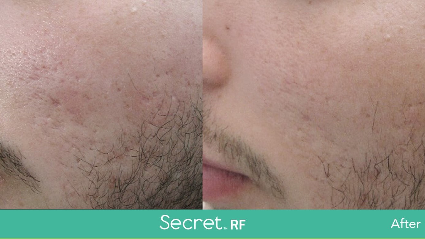 Skin Smoothing Results!